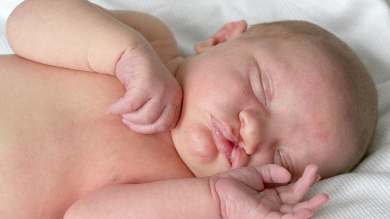 Bebé con fisura labiopatina