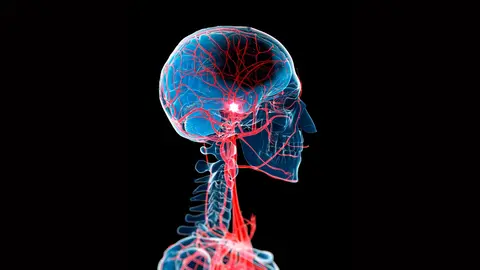 Se disparan los ictus e infartos entre los j&oacute;venes