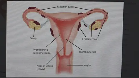 Endometriosis