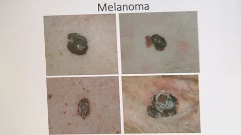 Melanoma