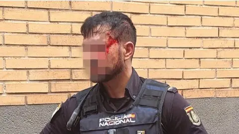 Un agente de la Polic&iacute;a Nacional sufre un traumatismo craneoencef&aacute;lico y seis puntos de sutura al ser agredido con una estaca en Murcia (foto: JUPOL)