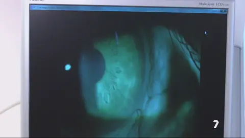 Glaucoma: la principal causa de ceguera irreversible en el mundo